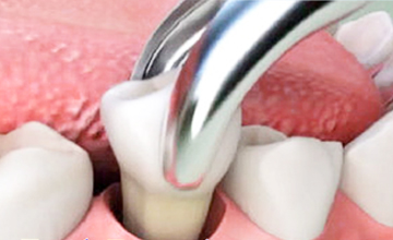 BrownField Dental Tooth Extractions service