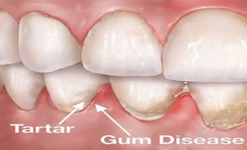BrownField Dental Periodontal (Gum) Disease service
