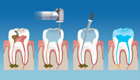 BrownField Dental Endodontics Therapy service
